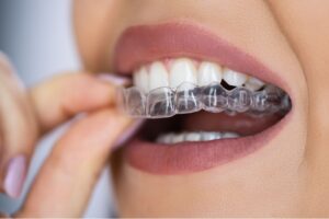 Invisalign in woman's mouth being used